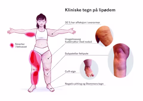 Kliniske tegn på lipødem