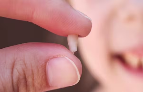 Picture of a tooth where parts of the root is resorbed